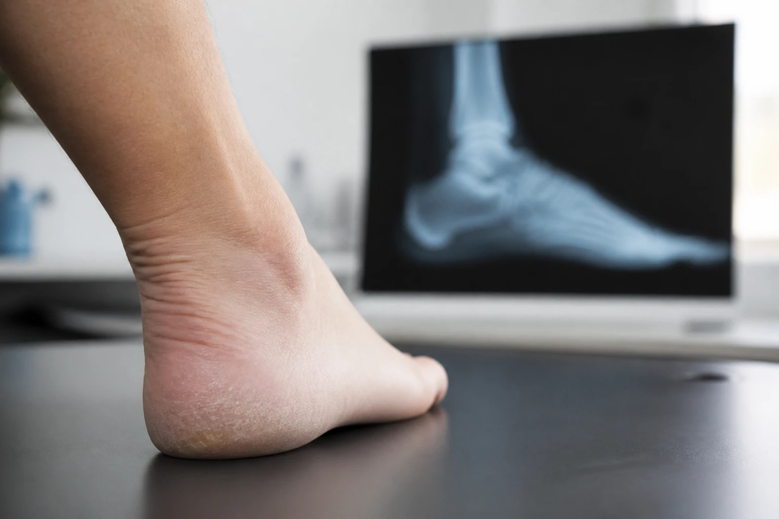 Gros plan sur un talon douloureux évoquant une épine calcanéenne, en cabinet médical